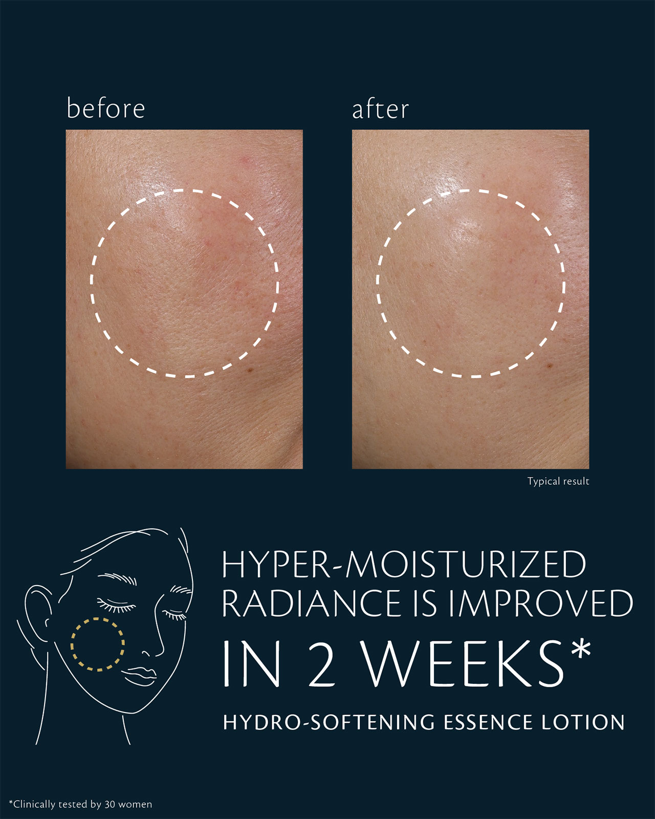 Photo of clinical test results for HYDRO-SOFTENING ESSENCE LOTION on 30 women, showing improved radiance after ภายใน 2 สัปดาห์ and enhanced moisture retention after 4 weeks. The image compares cheek areas before and after use, with the circled areas showing a visibly smoother and more hydrated appearance.
