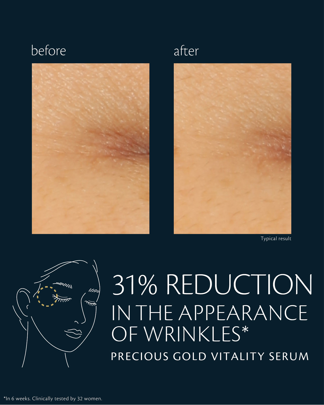 Photo of before-and-after comparison of skin using "PRECIOUS GOLD VITALITY SERUM." In the &ldquo;before&rdquo; image (left), crow&rsquo;s feet are more visible; in the &ldquo;after&rdquo; image (right), the appearance of wrinkles is reduced by 31%. Clinical test conducted over ภายใน 6 สัปดาห์ with 32 women.