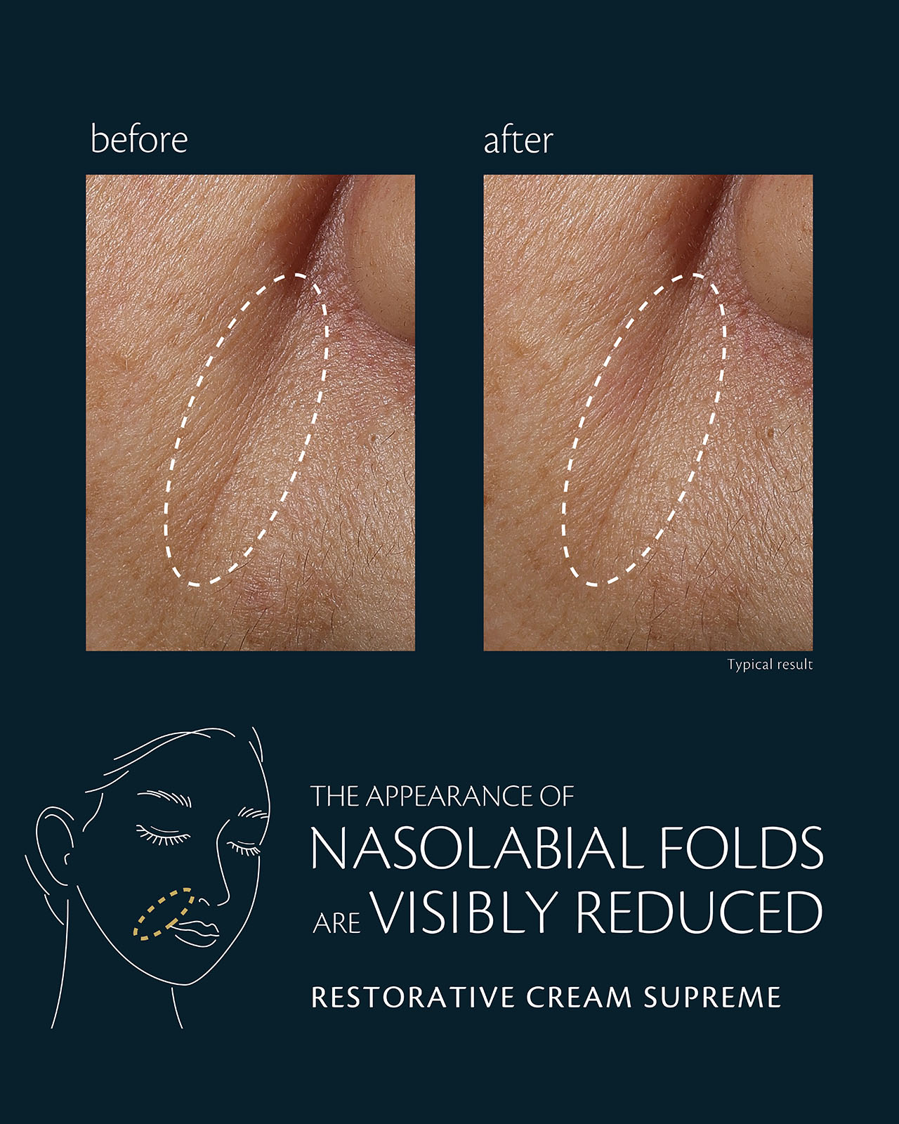 Photo of clinical test results for HYDRO-SOFTENING ESSENCE LOTION on 30 women, showing improved radiance after ภายใน 2 สัปดาห์ and enhanced moisture retention after 4 weeks. The image compares cheek areas before and after use, with the circled areas showing a visibly smoother and more hydrated appearance.