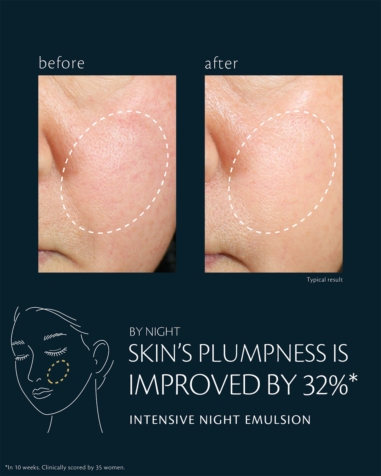 Photo of before-and-after comparison of cheek skin showing a 32% improvement in plumpness after using INTENSIVE NIGHT EMULSION. The left (before) shows dryness and slight loss of volume, while the right (after) appears plumper and firmer. *In ภายใน 10 สัปดาห์, clinically scored by 35 women.