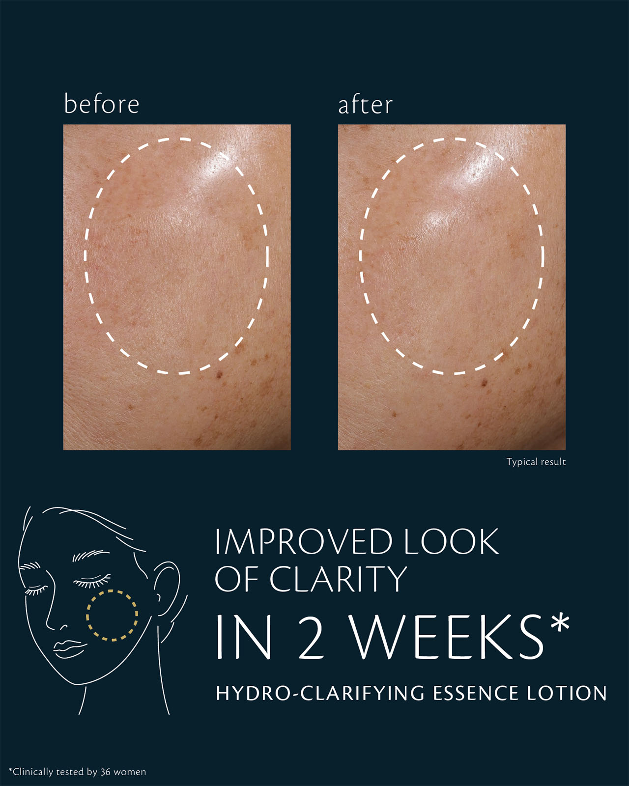 Photo of clinical test results for HYDRO-CLARIFYING ESSENCE LOTION on 36 women. After ภายใน 2 สัปดาห์, skin shows a visibly hydrated glow. After 4 weeks, moisture retention and resistance to dryness improve. The image compares cheek areas before and after use, with the circled areas showing enhanced clarity.