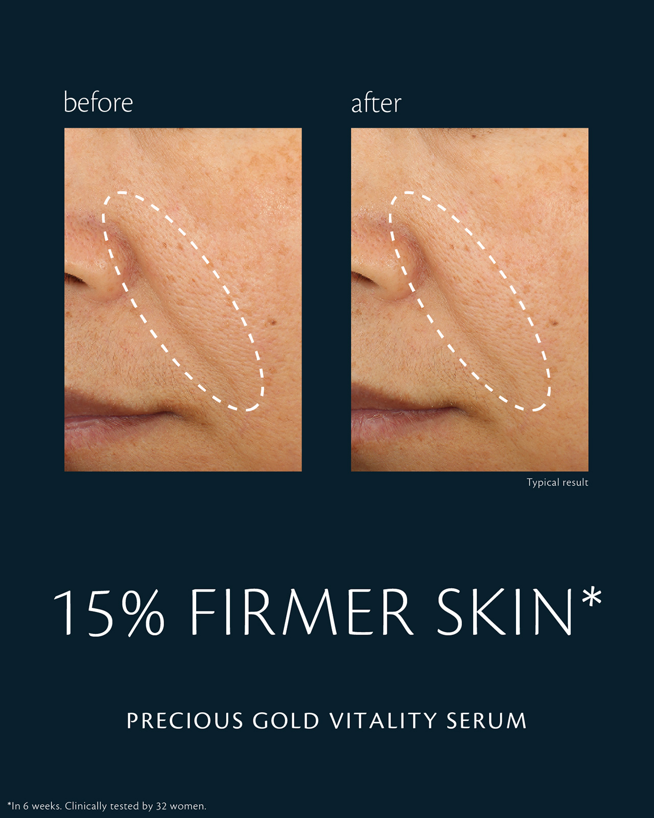 Photo of before-and-after comparison of skin using "PRECIOUS GOLD VITALITY SERUM." In the &ldquo;before&rdquo; image (left), skin firmness on the cheek appears diminished; in the &ldquo;after&rdquo; image (right), firmness is improved by 15%. Clinical test conducted over ภายใน 6 สัปดาห์ with 32 women.
